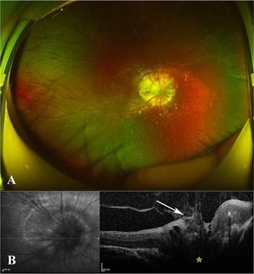 Case Report: Multimodal Imaging in a Rare Case of Morning Glory Disc Anomaly Complicated With Choroidal Ossification